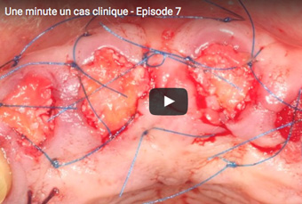 Vidéo | Une minute, un cas clinique - Chirurgie