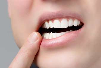 L’ANSM interdit certains produits de blanchiment dentaire