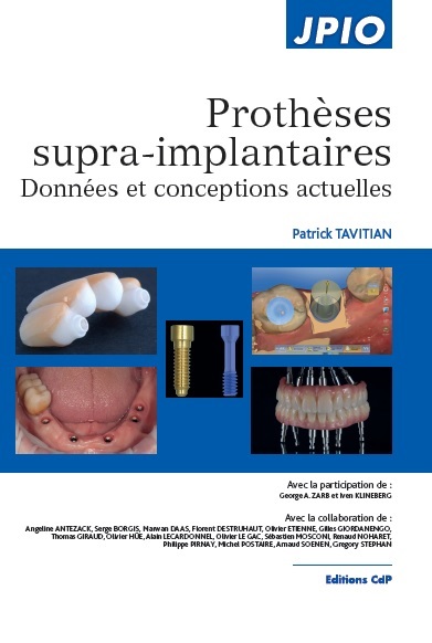 Prothèses supra-implantaires